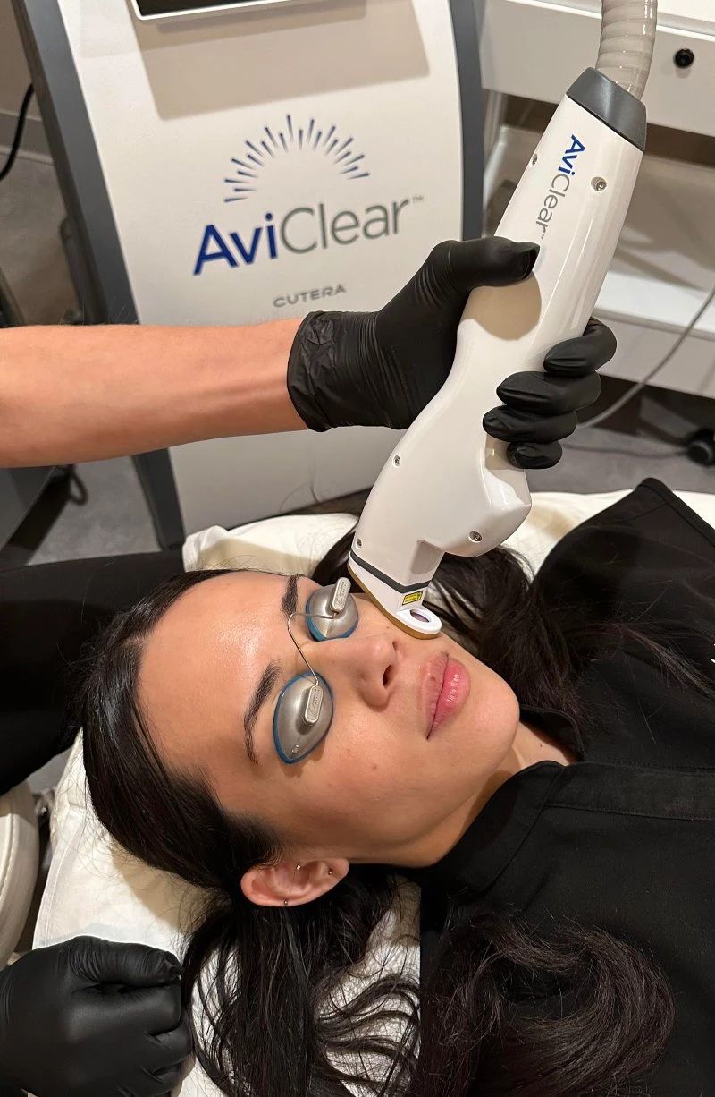 Laser Therapy for Acne Scars: When It’s Time and What to Know