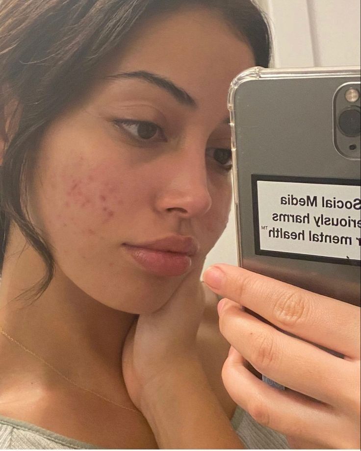 cindy kimberly mirror selfie showing acne scars