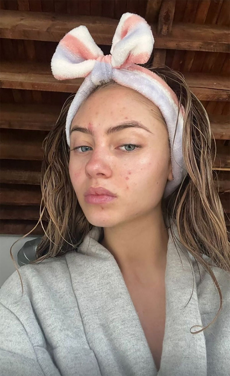 girl wearing headband showing acne