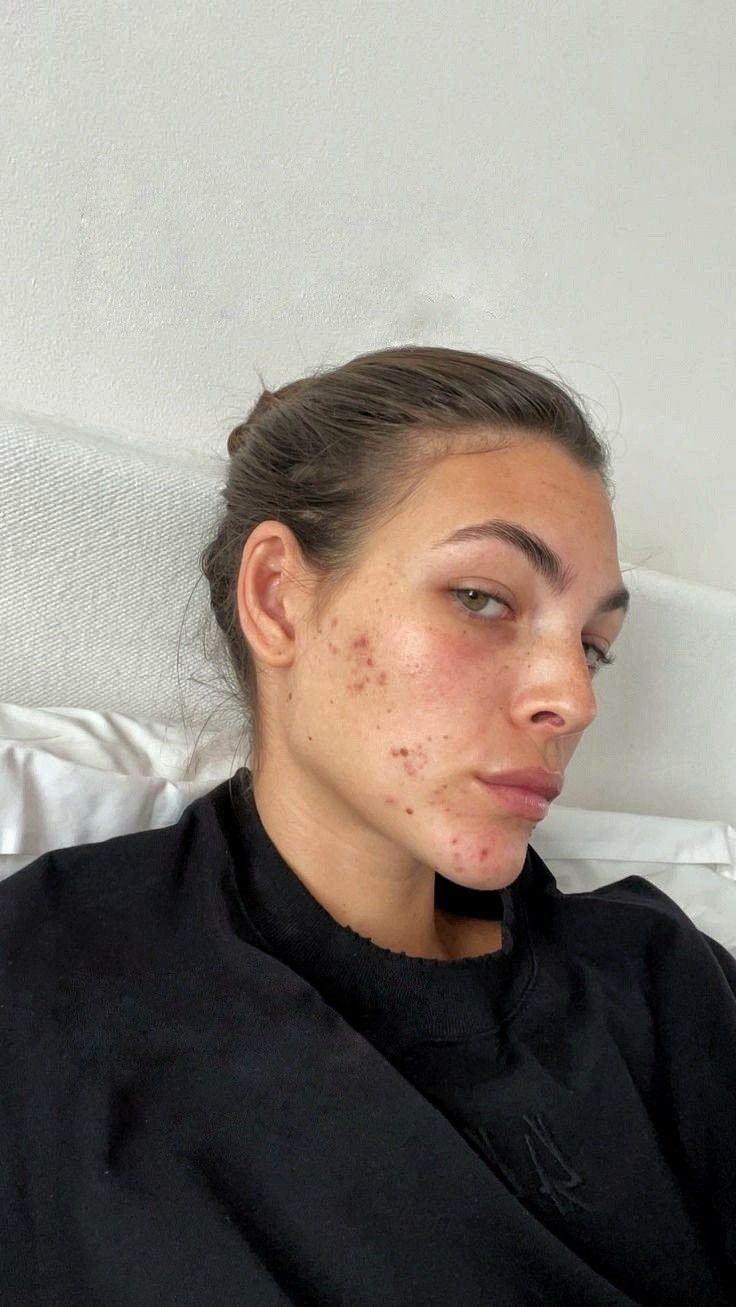 vittoria ceretti showing acne scars