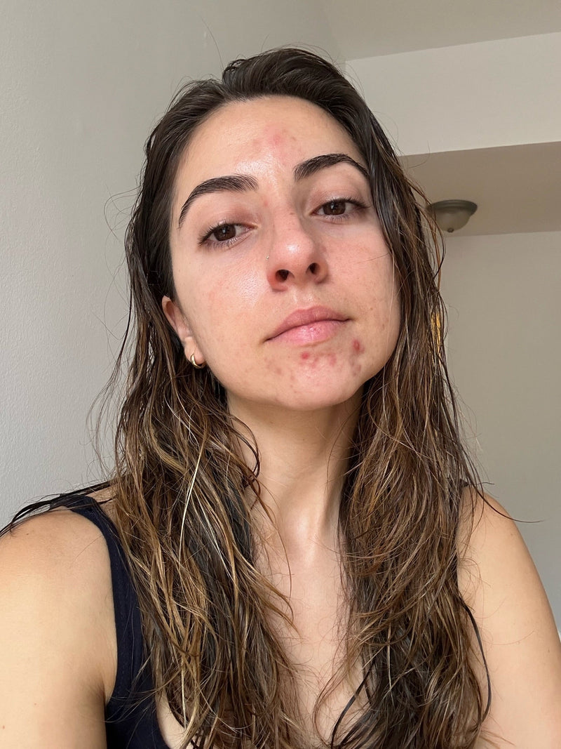 Let Your Skin Just…Exist: Embracing Acne Neutrality