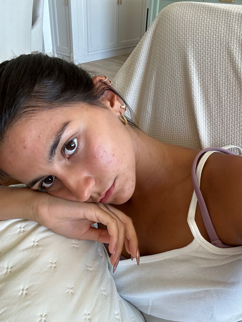 woman leaning against arm showing acne scars on face