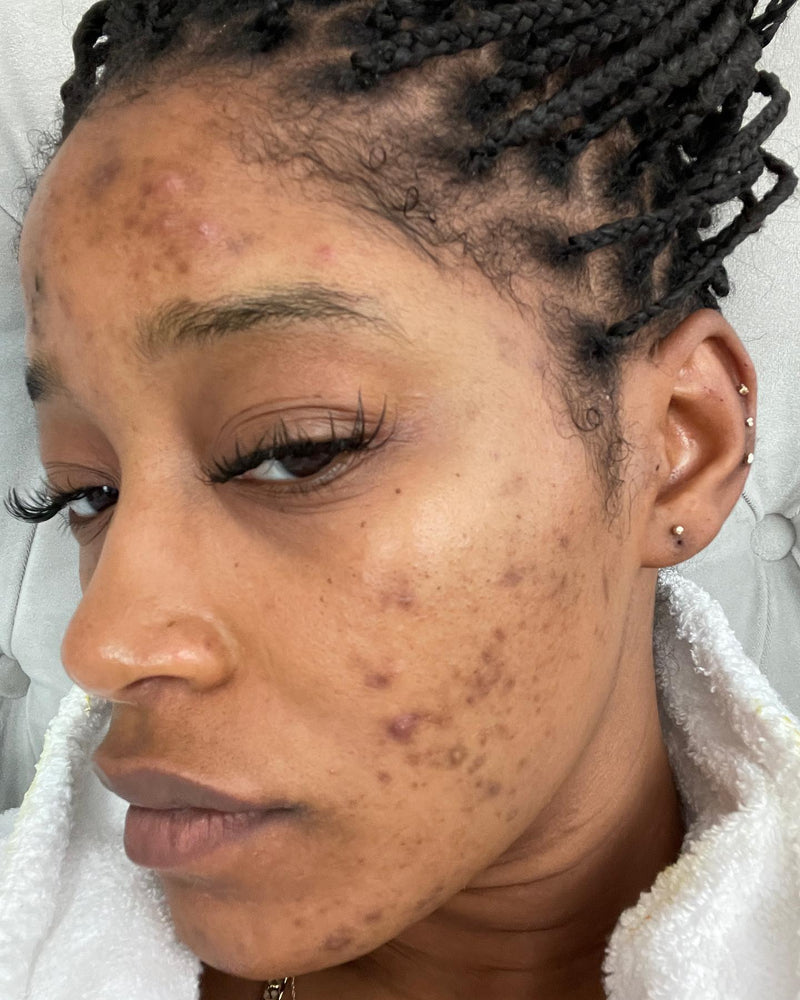 PCOS, Acne, and Acceptance: Real Talk From the banu Community