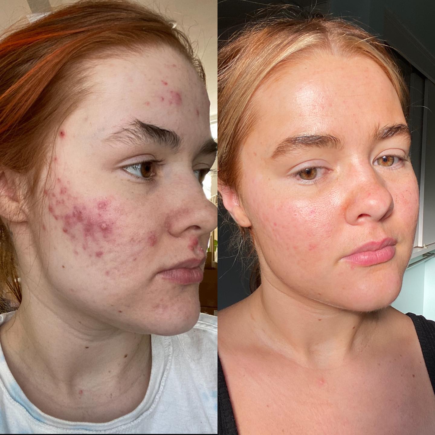 Accutane: What to Know Before You Say Yes