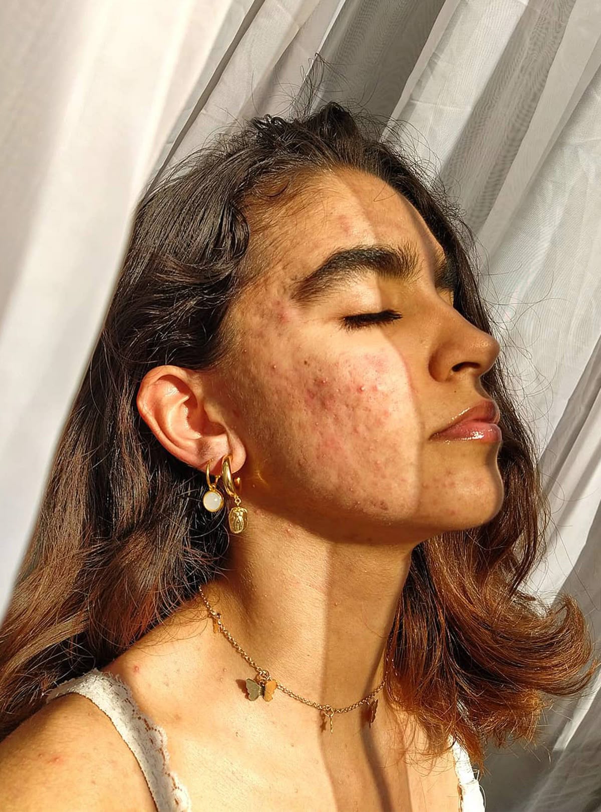 girl with cystic acne closing eyes in the sunshine