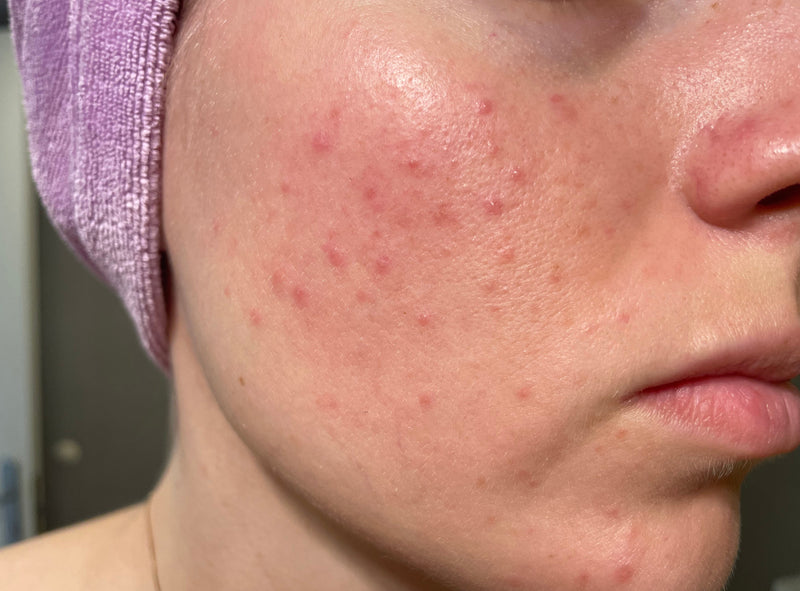 clogged pores and red bumps on right cheek