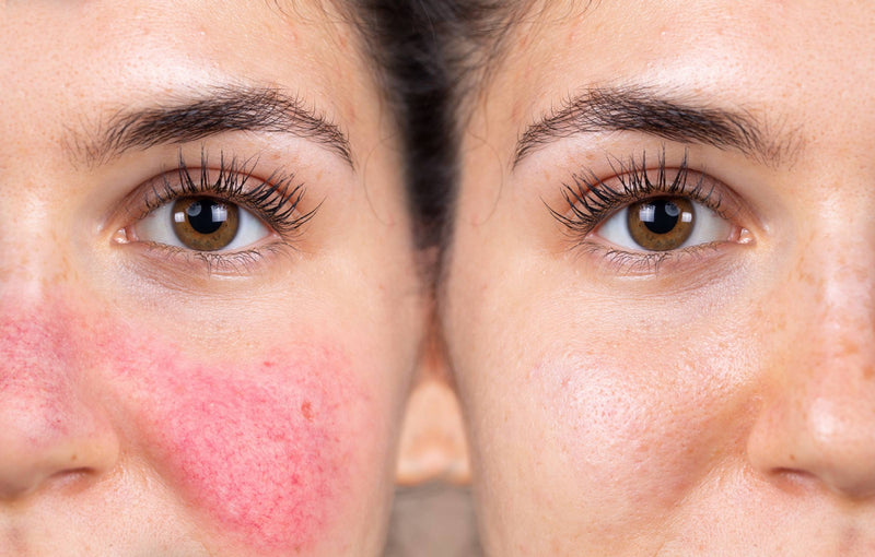 How to Tell If You Have Acne: Acne vs. Rosacea