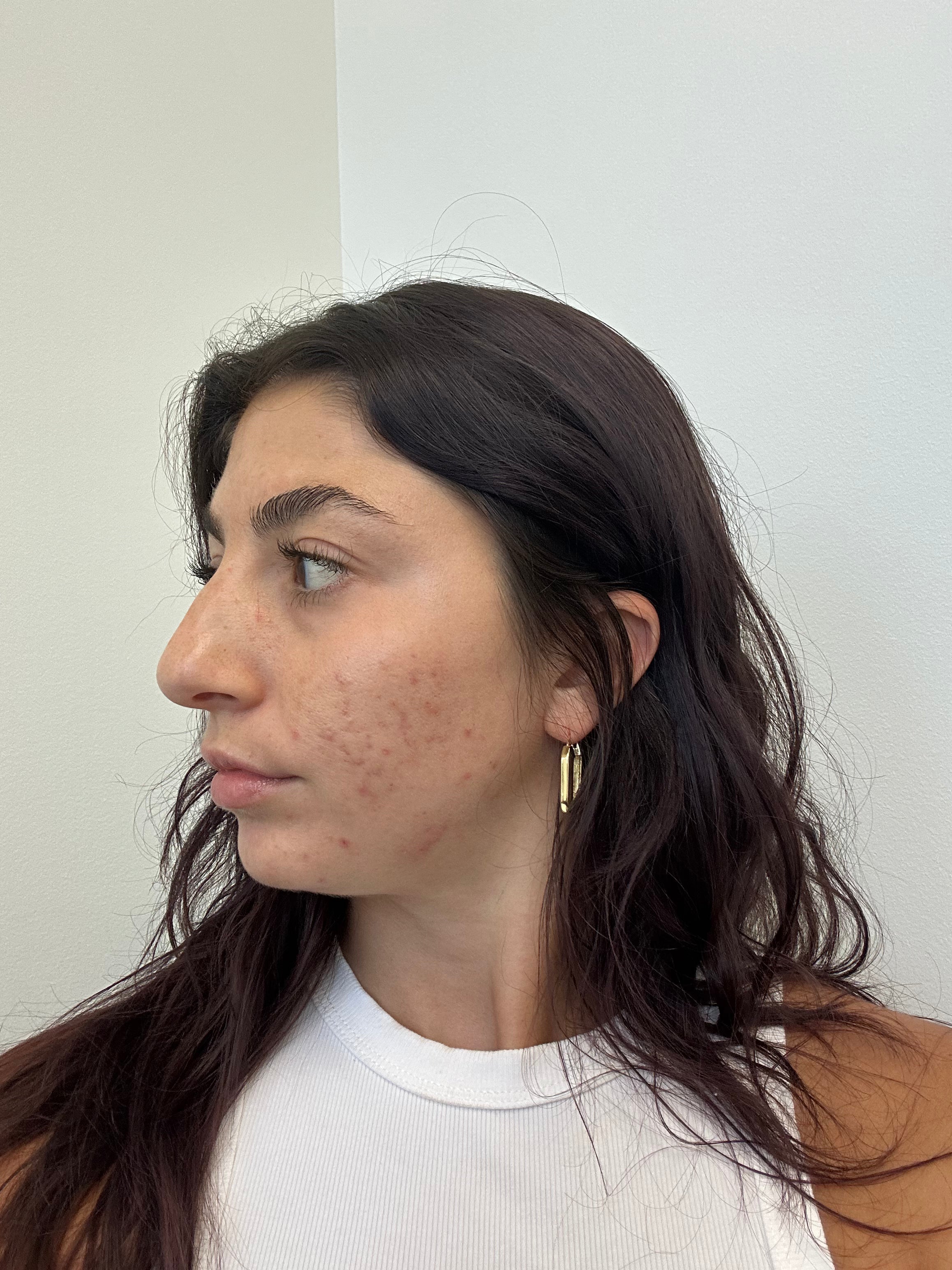 woman looking off to the side showing cystic acne on cheek