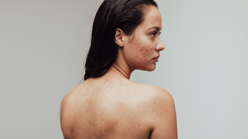 Body Breakouts Are Definitely a Thing — Here’s How to Manage