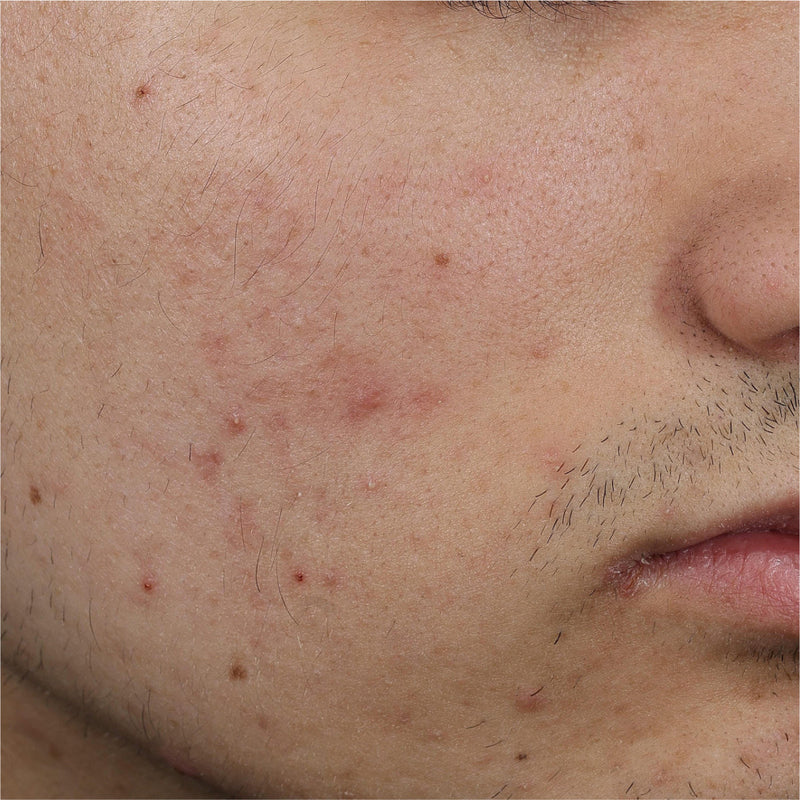 Breaking Out? It Might Be Fungal Acne — Here’s What to Know