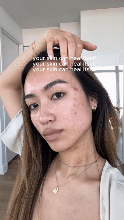The Ultimate Guide to Fading Acne Marks — and Knowing What You're Dealing With