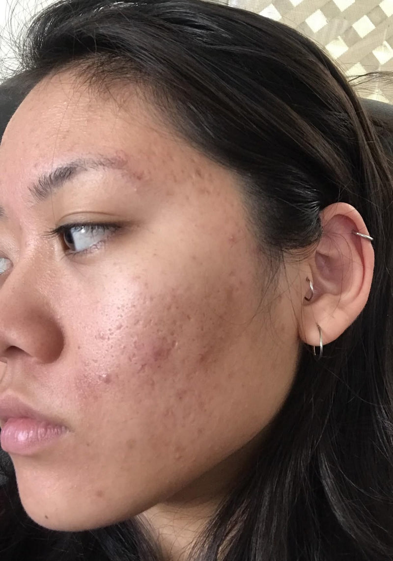 woman showing acne marks on cheek