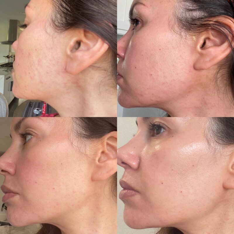 woman showing progress from fungal acne