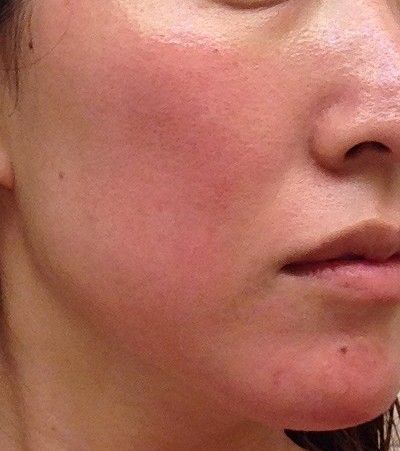 up close image of rosacea on woman's cheek
