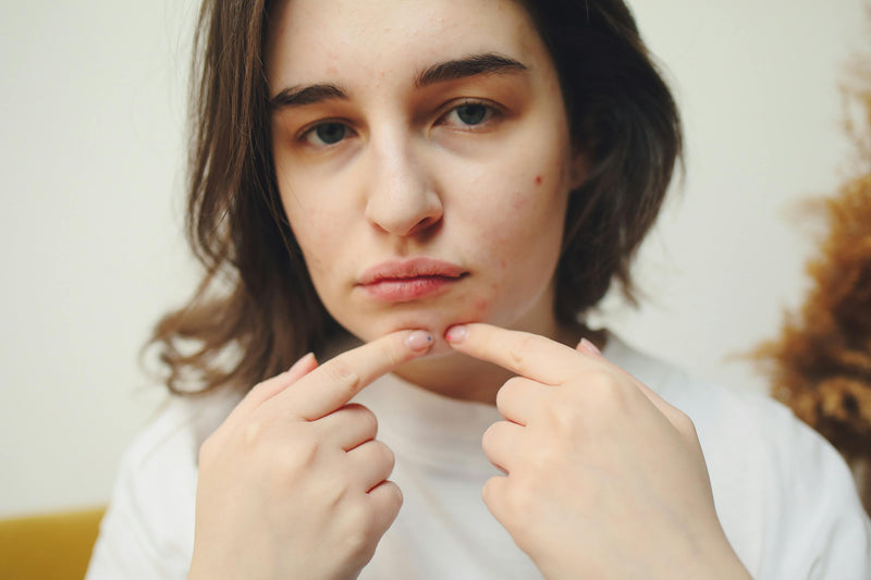 How to Pop a Pimple (If You’re Going to Do It Anyway)