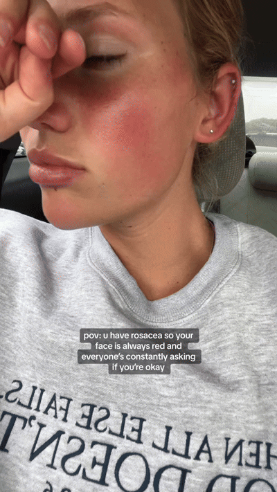 Is It Acne or Rosacea? Let’s Break It Down
