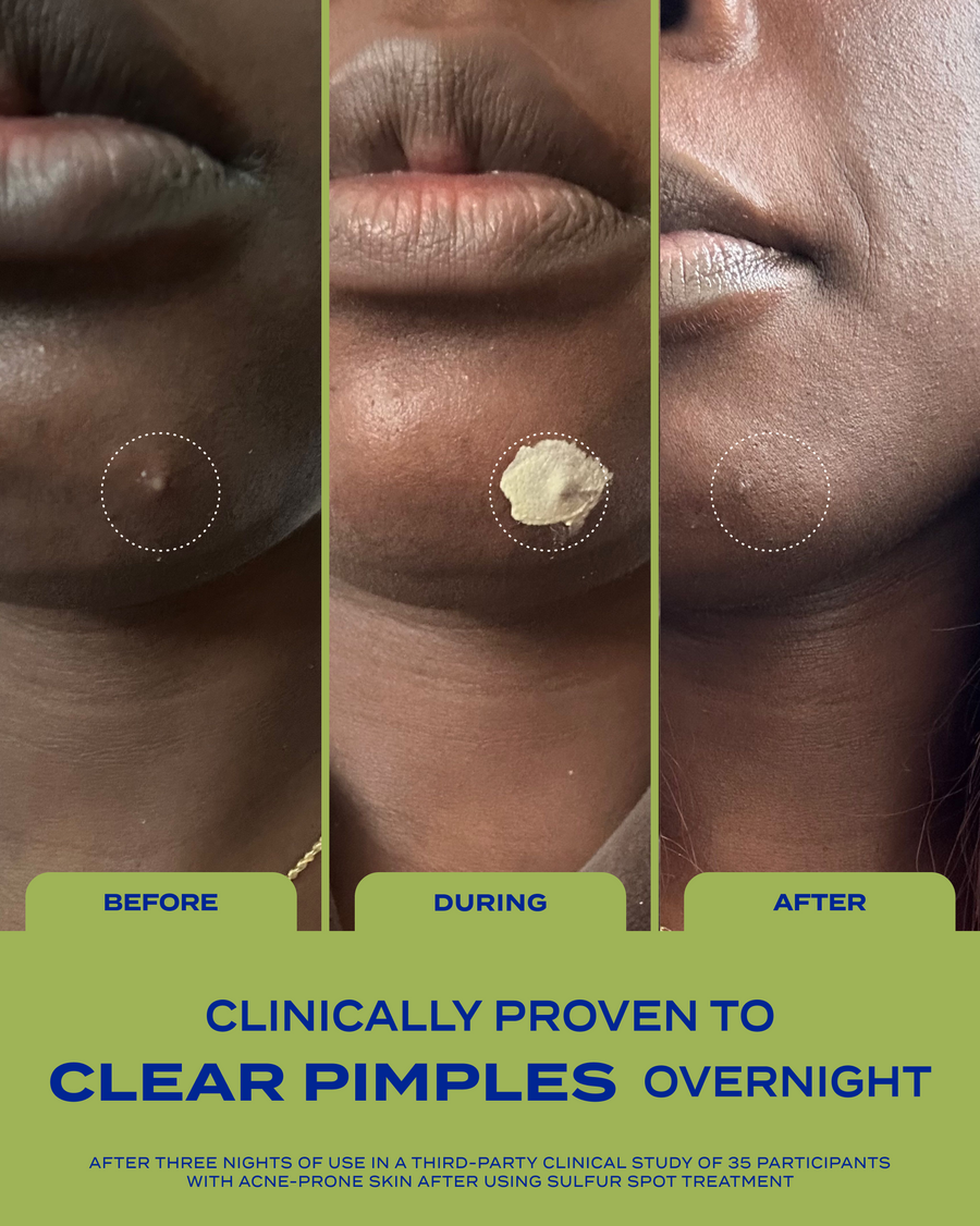 10% Sulfur Spot Treatment