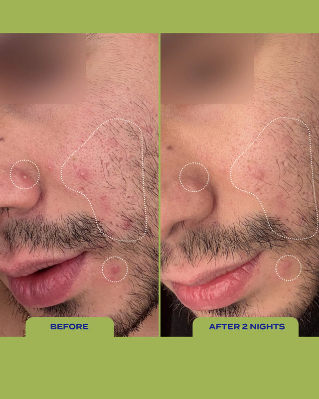 Before and after 2 nights