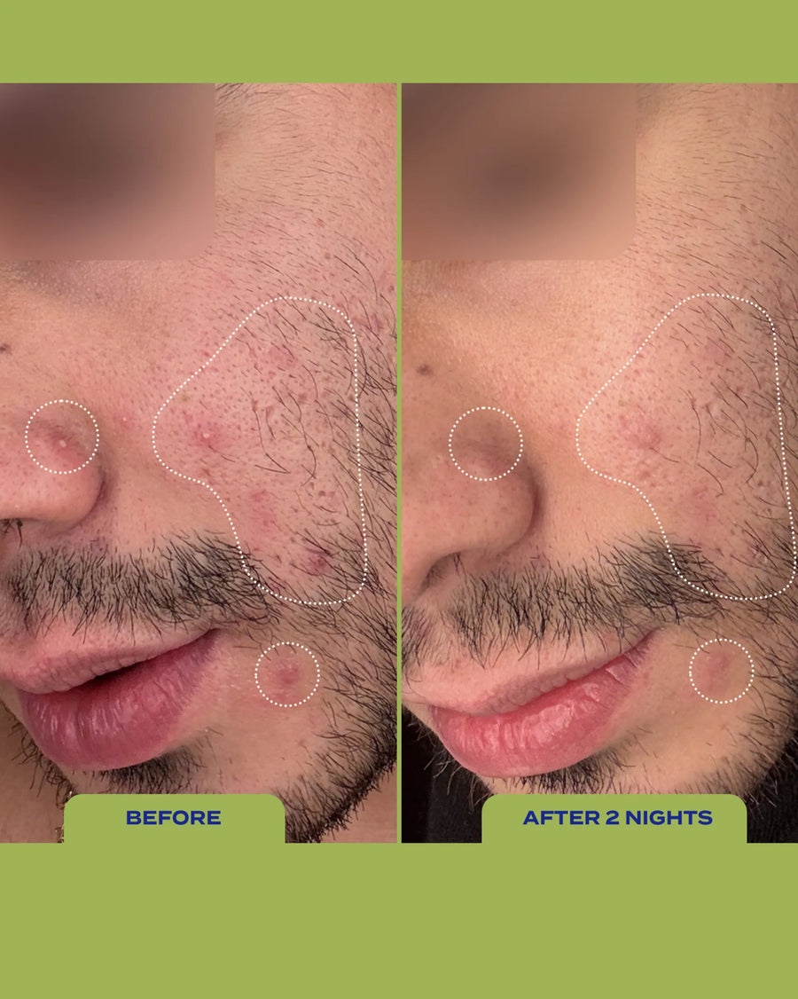 10% Sulfur Spot Treatment Duo