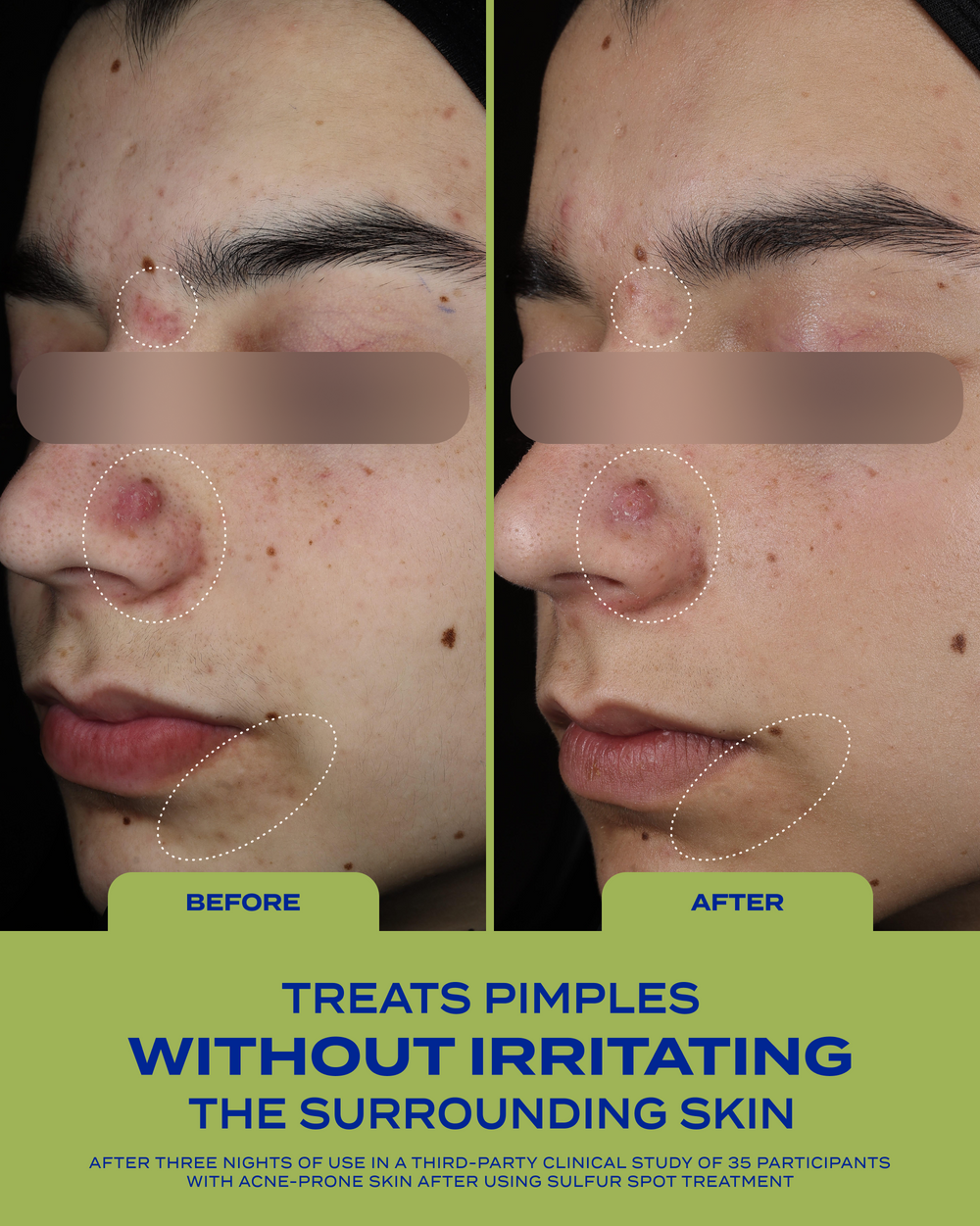 10% Sulfur Spot Treatment