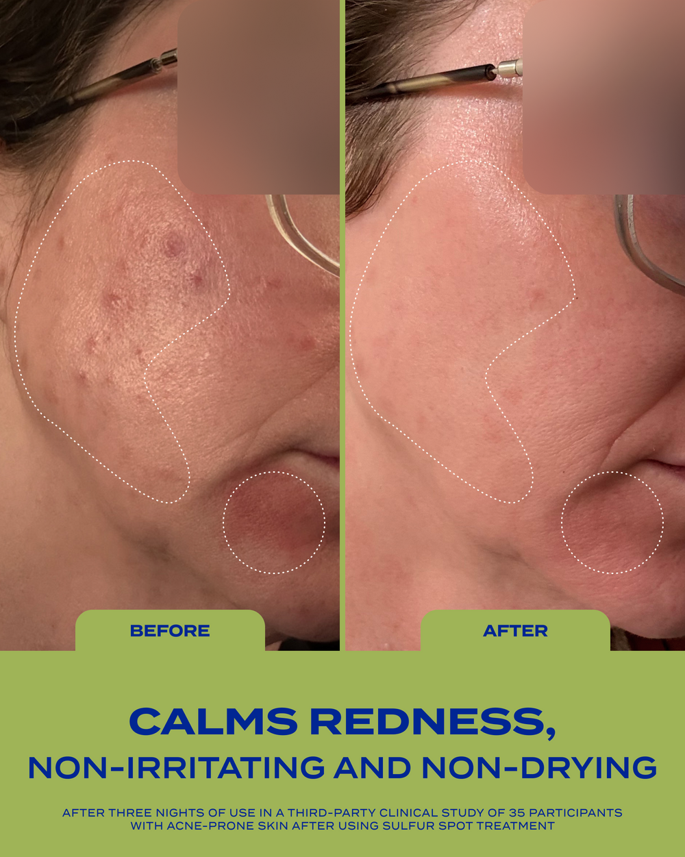 10% Sulfur Spot Treatment