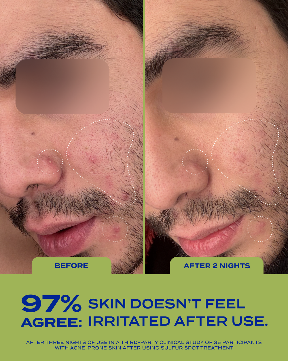 10% Sulfur Spot Treatment