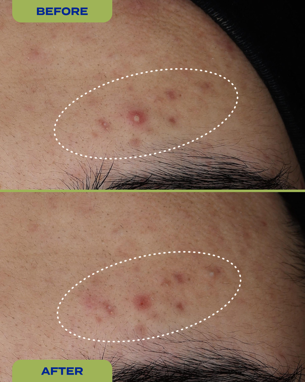 10% Sulfur Spot Treatment