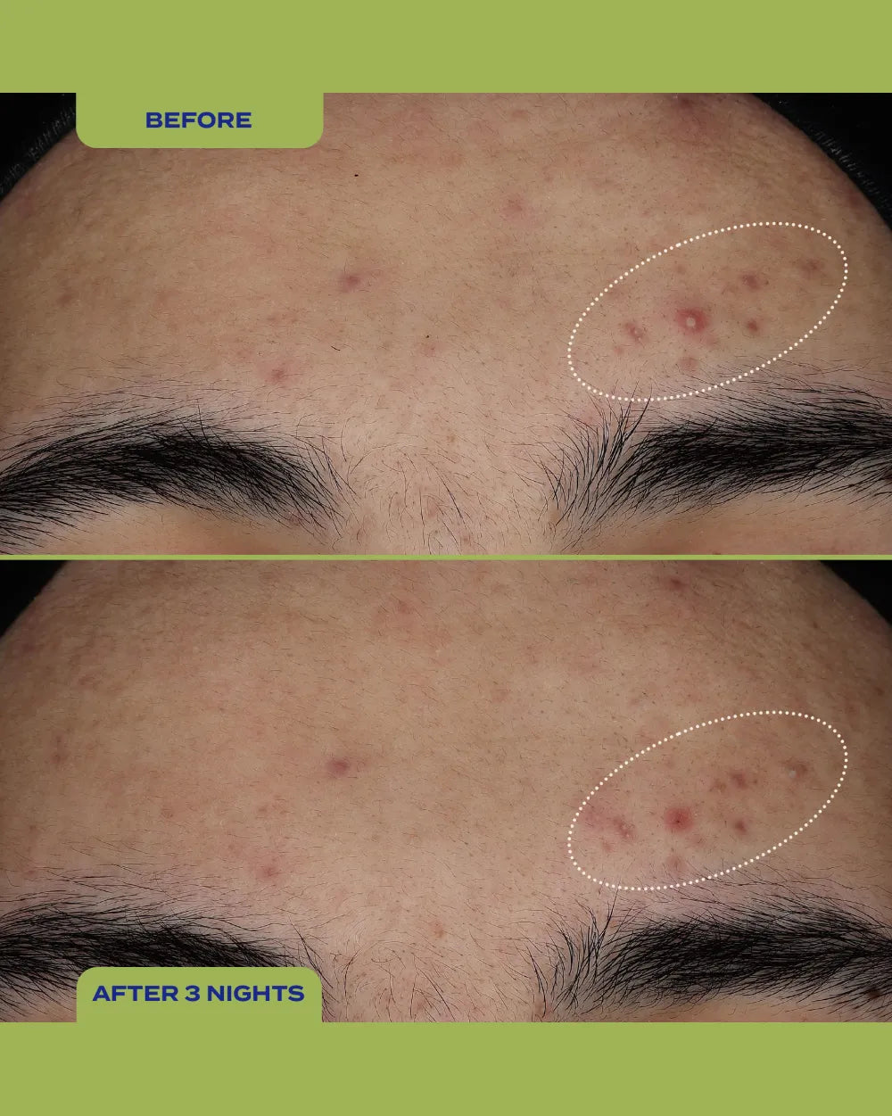 10% Sulfur Spot Treatment Duo