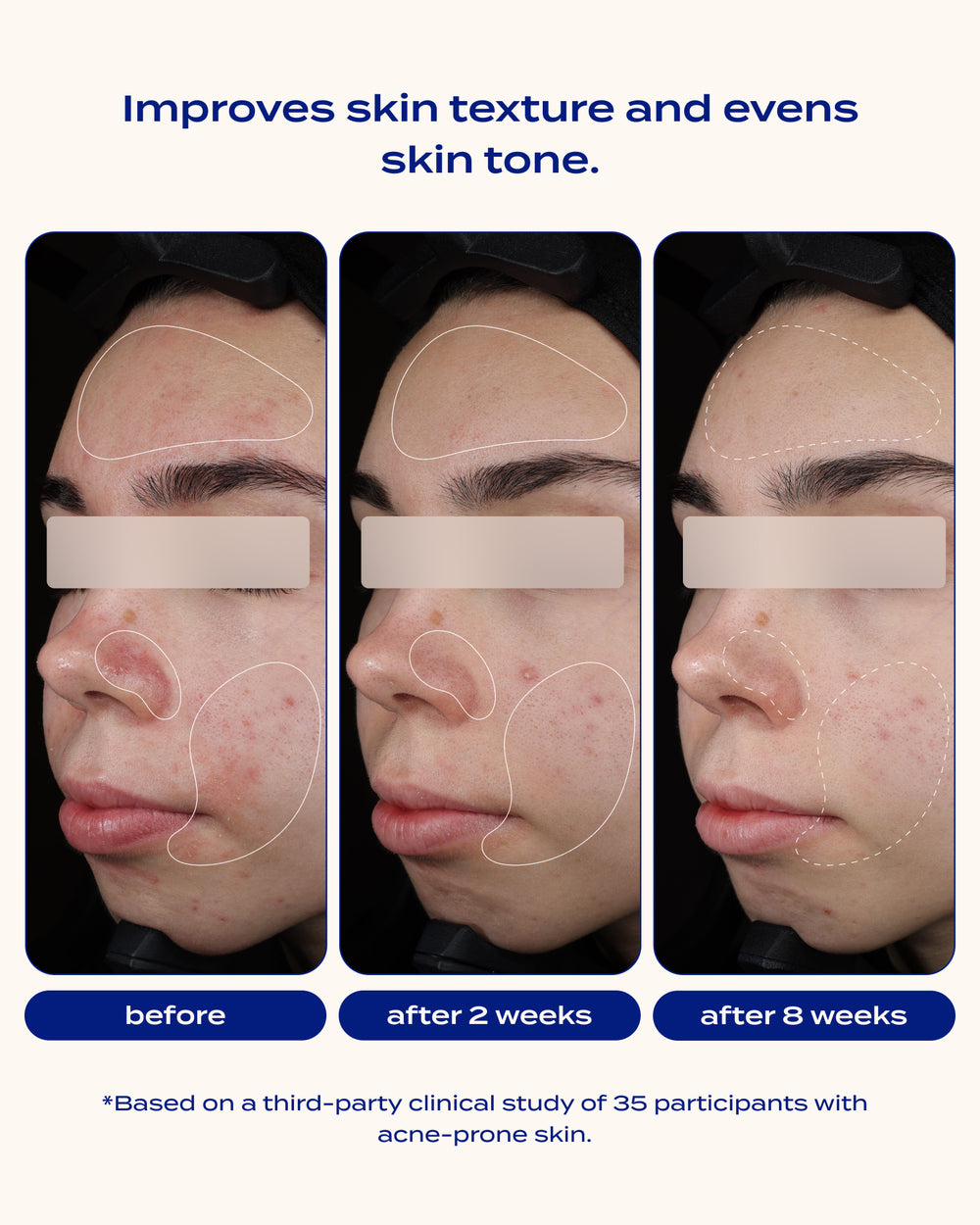Blemish Control & Exfoliating Serum
