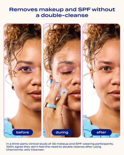 Acne-Clearing Essentials