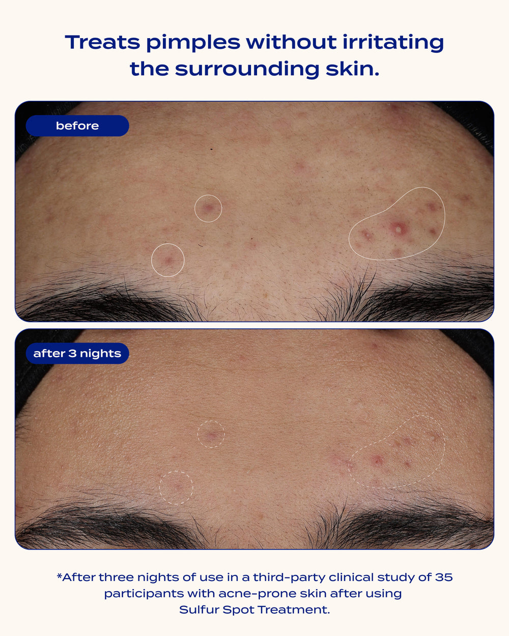Sulfur Spot Treatment
