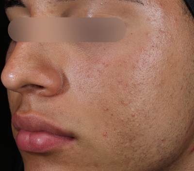 After using Deep Drench Moisturizer