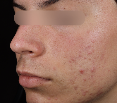 After using Deep Drench Moisturizer