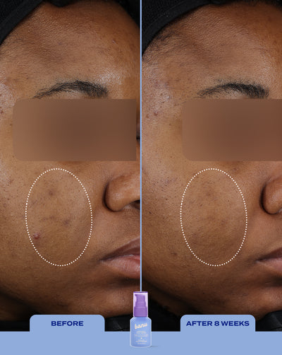 Treat, Fade & Prevent Routine