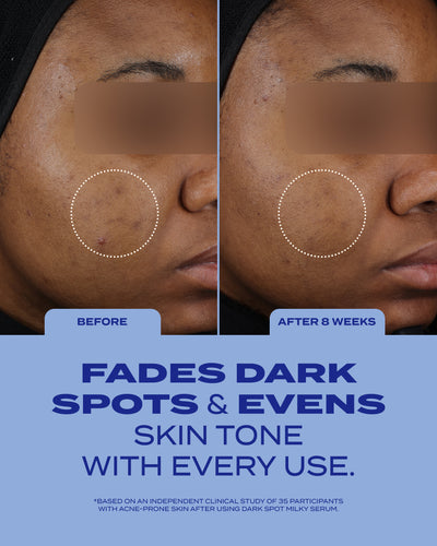 Dark Spot Milky Serum