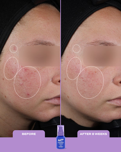 Treat, Fade & Prevent Routine