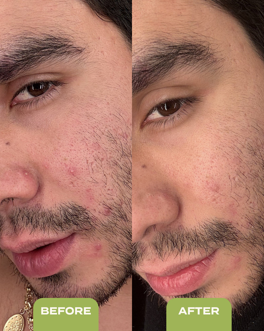 10% Sulfur Spot Treatment Duo