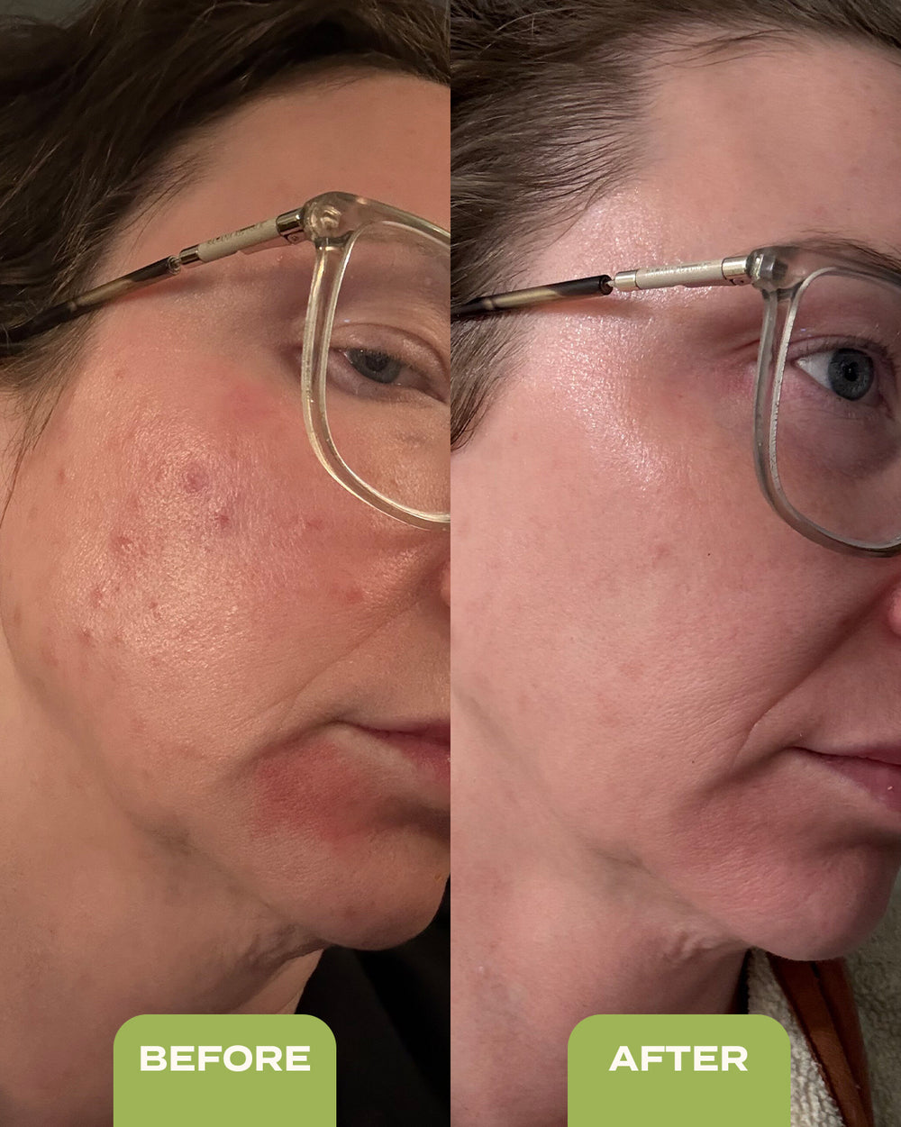 10% Sulfur Spot Treatment Duo