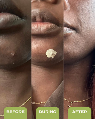 10% Sulfur Spot Treatment