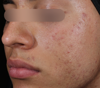 Before using Deep Drench Moisturizer