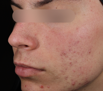 Before using Deep Drench Moisturizer